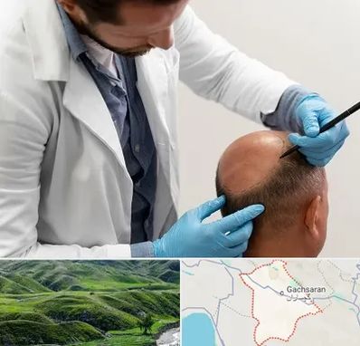 کاشت مو به روش تکثیری در گچساران