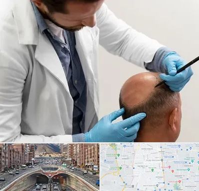 کاشت مو به روش تکثیری در منطقه 10 تهران 