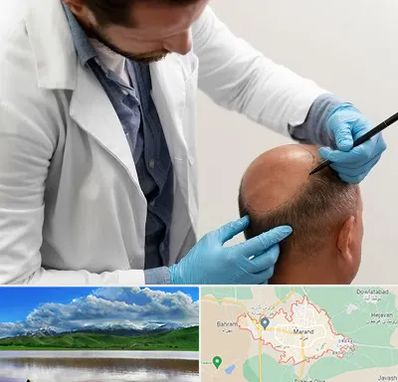 کاشت مو به روش تکثیری در مرند