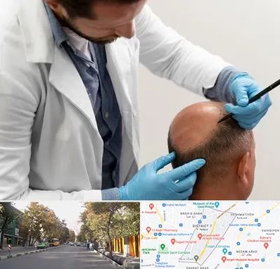 کاشت مو به روش تکثیری در شریعتی 