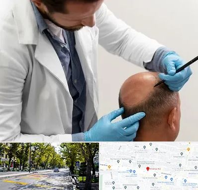 کاشت مو به روش تکثیری در میرداماد 