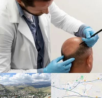 کاشت مو به روش تکثیری در رودهن
