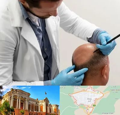 کاشت مو به روش تکثیری در خوی