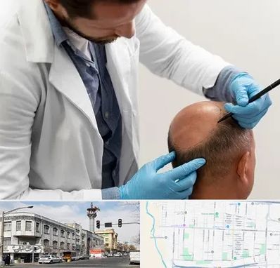 کاشت مو به روش تکثیری در 17شهریور