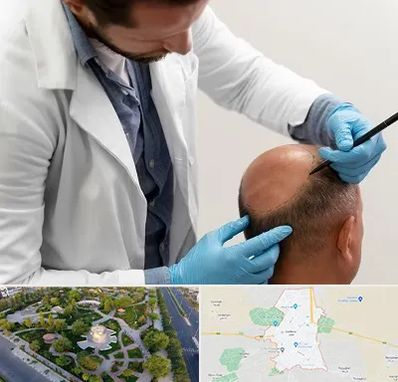 کاشت مو به روش تکثیری در کاشمر