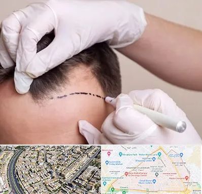 کاشت مو به روش SUT در شهرک غرب مشهد