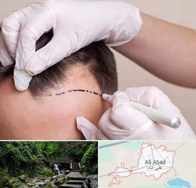 کاشت مو به روش SUT در علی‌ آباد کتول
