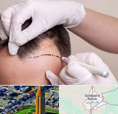 کاشت مو به روش SUT در گنبد کاووس