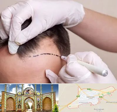 کاشت مو به روش SUT در سمنان