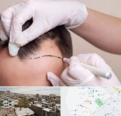 کاشت مو به روش SUT در شمیران نو