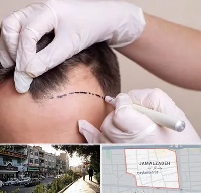 کاشت مو به روش SUT در خیابان جمالزاده
