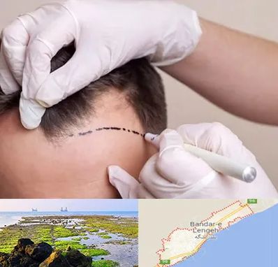 کاشت مو به روش SUT در بندرلنگه