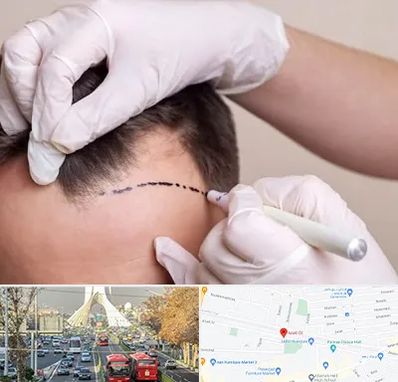 کاشت مو به روش SUT در خیابان آزادی 