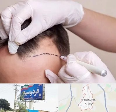 کاشت مو به روش SUT در فردوسیه شهریار