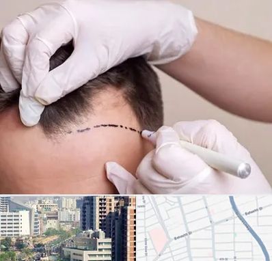 کاشت مو به روش SUT در خیابان بهشتی