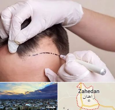 کاشت مو به روش SUT در زاهدان