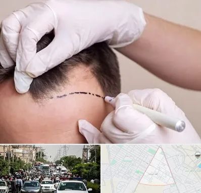 کاشت مو به روش SUT در سیدی مشهد