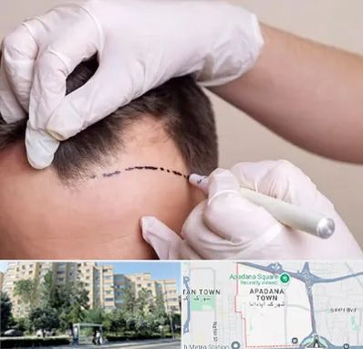 کاشت مو به روش SUT در آپادانا