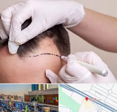 کاشت مو به روش SUT در لاله پارک تبریز