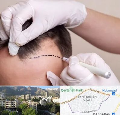 کاشت مو به روش SUT در اختیاریه 