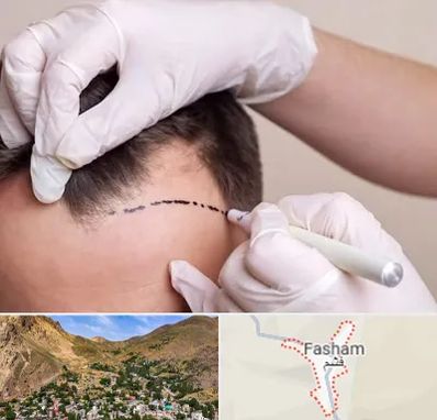 کاشت مو به روش SUT در فشم