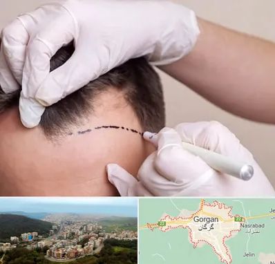 کاشت مو به روش SUT در گرگان