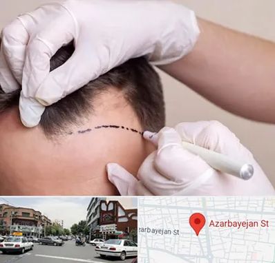 کاشت مو به روش SUT در خیابان آذربایجان