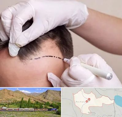 کاشت مو به روش SUT در خاش