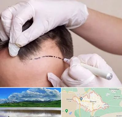 کاشت مو به روش SUT در مرند