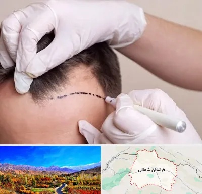 کاشت مو به روش SUT در خراسان شمالی