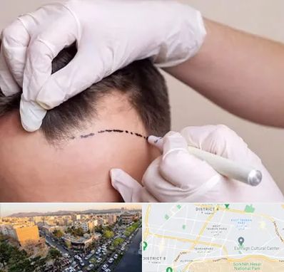 کاشت مو به روش SUT در تهرانپارس 