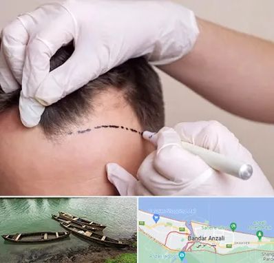 کاشت مو به روش SUT در بندر انزلی