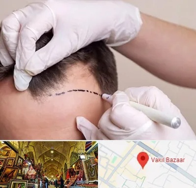 کاشت مو به روش SUT در بازار وکیل شیراز