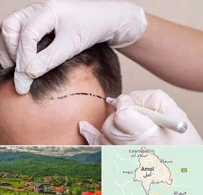 کاشت مو به روش SUT در آمل