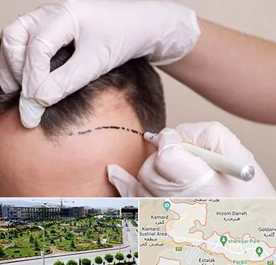 کاشت مو به روش SUT در پردیس