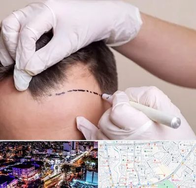 کاشت مو به روش SUT در منظریه رشت