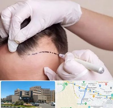 کاشت مو به روش SUT در صیاد شیرازی مشهد