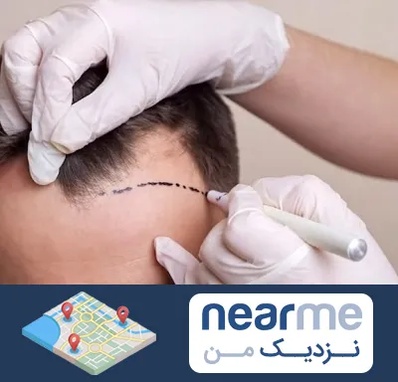 کاشت مو به روش SUT در نزدیک من