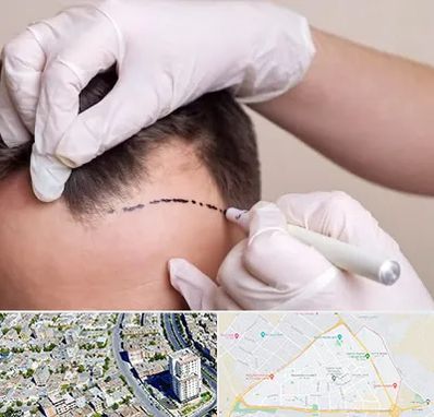 کاشت مو به روش SUT در قاسم آباد مشهد 