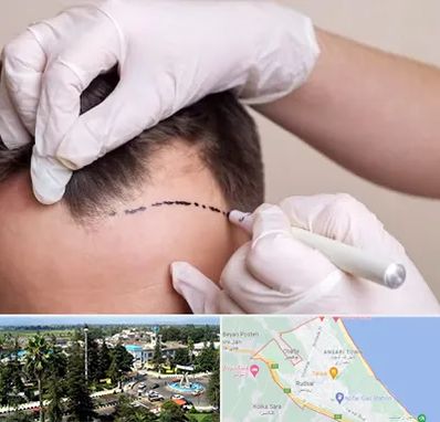 کاشت مو به روش SUT در رودسر