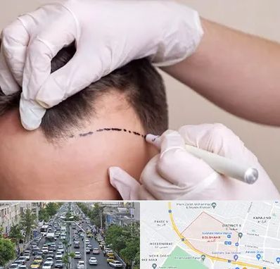 کاشت مو به روش SUT در گلشهر کرج