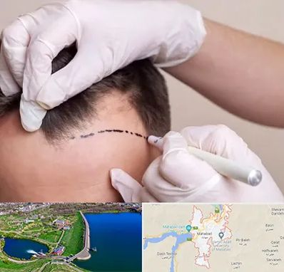 کاشت مو به روش SUT در مهاباد