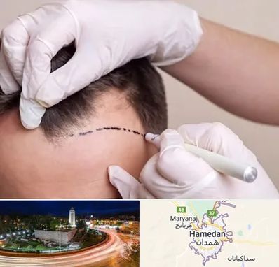 کاشت مو به روش SUT در همدان
