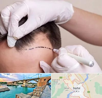 کاشت مو به روش SUT در دزفول