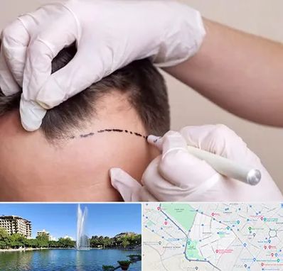 کاشت مو به روش SUT در کوهسنگی مشهد