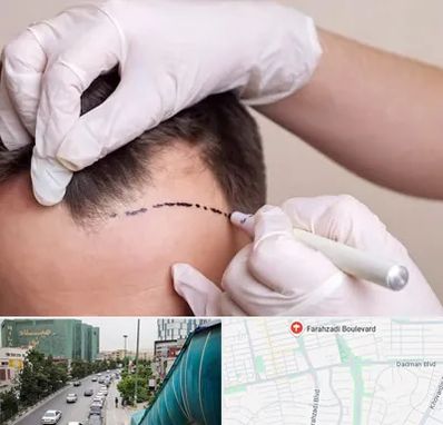 کاشت مو به روش SUT در بلوار فرحزادی