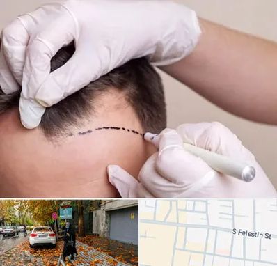 کاشت مو به روش SUT در خیابان فلسطین