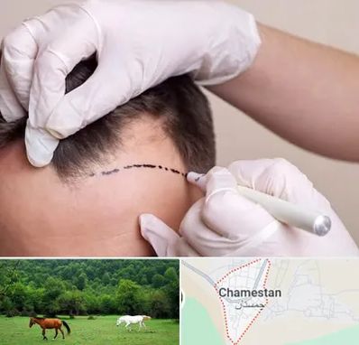 کاشت مو به روش SUT در چمستان
