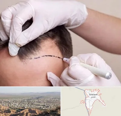 کاشت مو به روش SUT در اسفراین