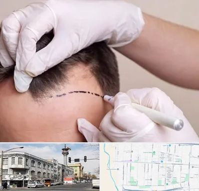 کاشت مو به روش SUT در 17شهریور